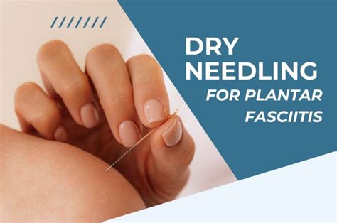 Dry Needling For Plantar Fasciitis Is It Effective