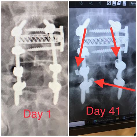 Question After Lumbar Fusion Rsurgery
