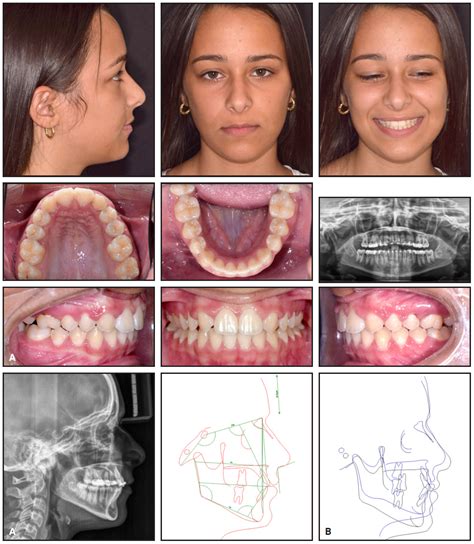 Space Closure In Lateral Incisor Agenesis Using TADs