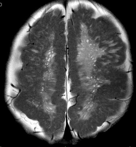 Cobblestone lissencephaly-MRI - Sumer's Radiology Blog