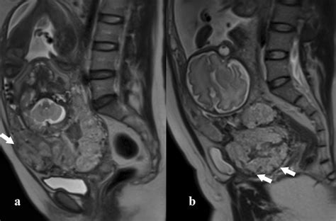 Placenta Percreta With S1 Invasion A And S2 Invasion B Sagittal