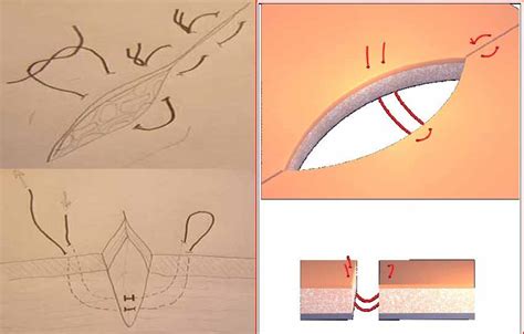 Técnicas de suturas