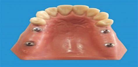 Stress Analysis Of Short Implants With Different Diameters I Tanta Dental Journal