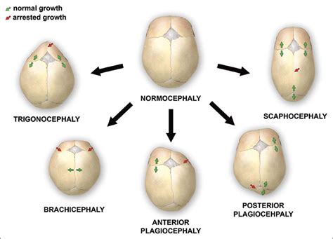 Craniosynostosis Sutures