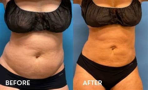 Smartlipo Before After Pictures Laser Lipo Results Photos