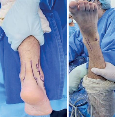 Figure 1 From Anterior And Posterior Ankle Arthroscopy In Prone