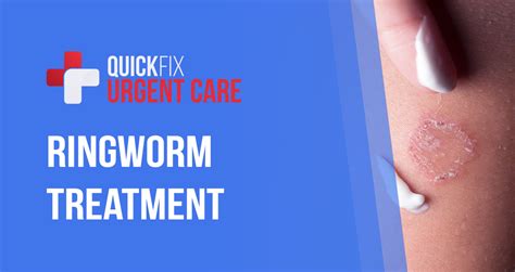 Ringworm Treatment | QuickFix Urgent Care