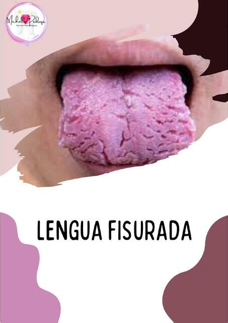 Lengua Fisurada Michelle Pedroza Udocz