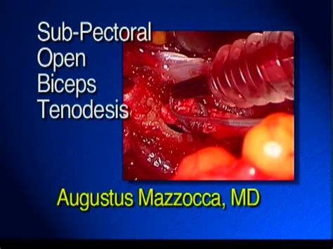 Arthrex Sub Pectoral Open Biceps Tenodesis