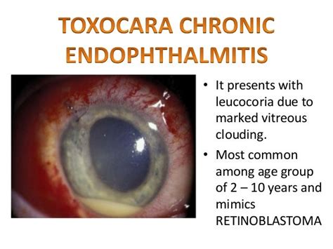 Toxocariasis