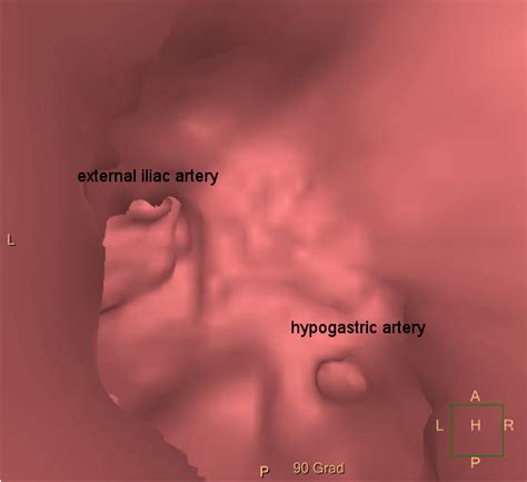 Revascularization of the hypogastric artery - v a s c n o w