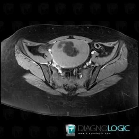 Cas Radiologie Kyste Dermo De Irm Diagnologic