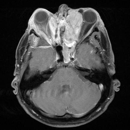 Olfactory Neuroblastoma Radiology Reference Article Radiopaedia Org