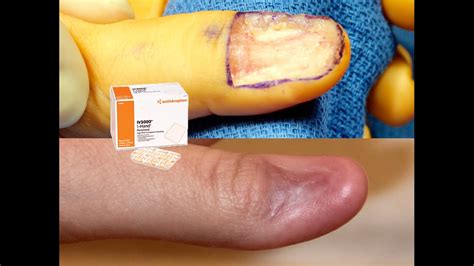 Iv 3000 Dressing Fingertip Informacionpublicasvetgobgt