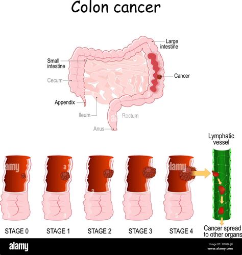 colon cancer. Colorectal oncology. Development of a malignant tumor ...