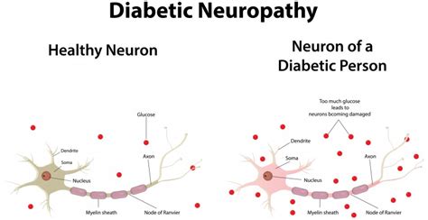 Diabetic Neuropathy Causes, Symptoms, Diagnosis And Treatment - Natural Health News