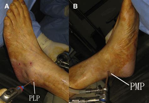 Decompression Of Posterior Ankle Impingement With Concomitant Anterior