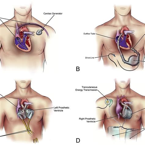 Illustrations of various cardiovascular implantable devices. a Cardiac ...