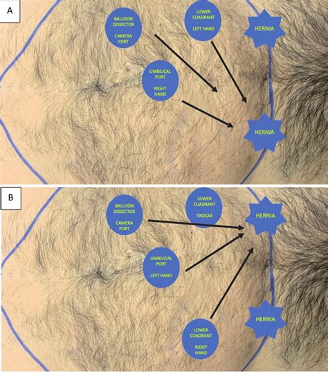 Etep Bilateral Inguinal Hernia Trocar Setup A Start With The Right