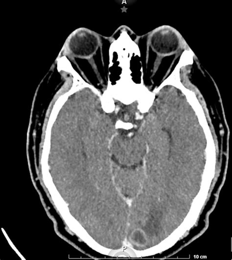 5 Tac Craneal Tumor Cerebral Ocronos Editorial Científico Técnica