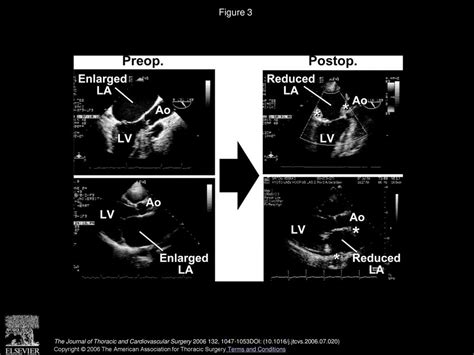 A Novel Atrial Volume Reduction Technique To Enhance The Cox Maze