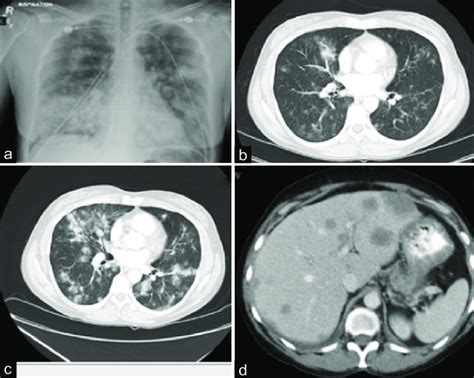 A Chest X Ray Revealing Bilateral Patch Pulmonary Opacities With