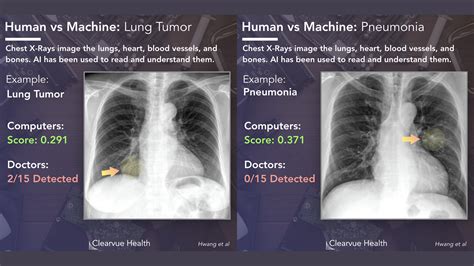 Qureai Ai For Chest Xrays