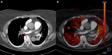 Dual Energy Computed Tomography And Pulmonary Embolism A B Dual