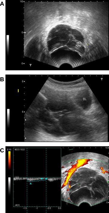 Ultrasonographic Examination Demonstrated A Large Uterine Cervical