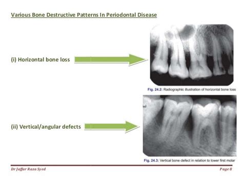 024.bone loss and patterns of bone destruction