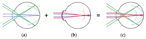 Jcm Free Full Text Multifocal Orthokeratology Versus Conventional Orthokeratology For Myopia