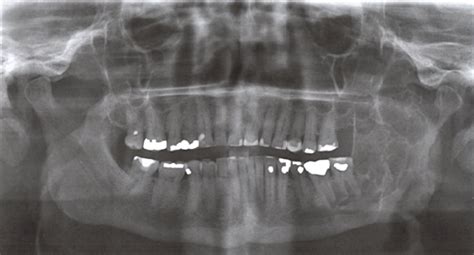 The Use Of Virtual Surgical Planning For Management Of Ameloblastoma A