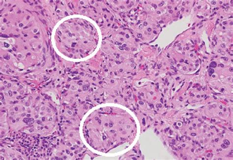 A Cardiac Paraganglioma Histology Multiple Large Groups Of