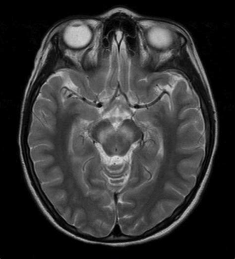 Patolog A Neurol Gica Aguda Por Enterovirus Revisi N De Casos Cl Nicos