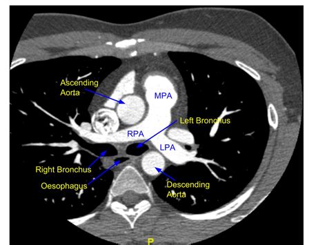 Pulmonary Artery Branch Anatomy