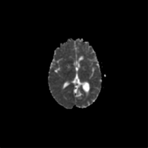 Lobar Hemorrhage Secondary To Cerebral Amyloid Angiopathy Image