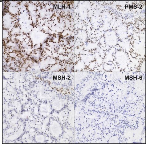 Msi Testing By Immunohistochemistry A And Molecular Microsatellite