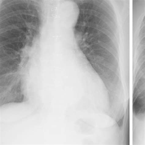 A Chest Radiography On Admission B Chest Radiography Just Before