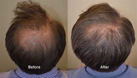 minoxidil Archives - Hair Restoration of the South