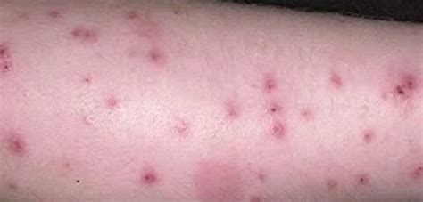 Bed Bug Bite - Pictures, Symptoms, Treatment