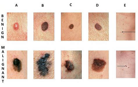 The Abcdes Of Skin Cancer Zona Med Spa