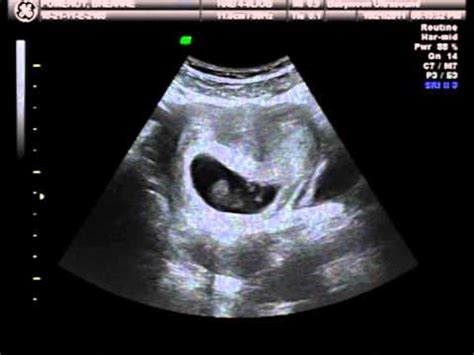 Vanishing Twin Syndrome Ultrasound