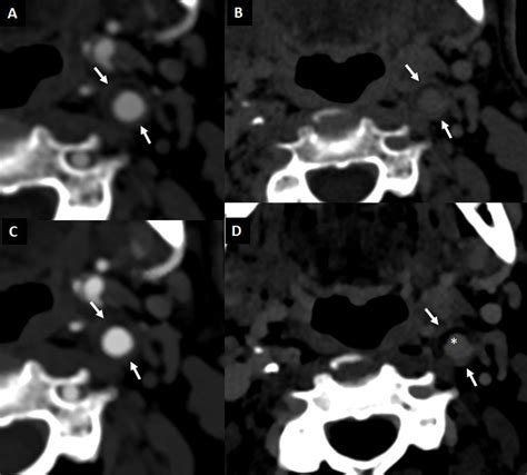 Mild Non Calcified Carotid Plaque Evaluated With CT Angiography Using