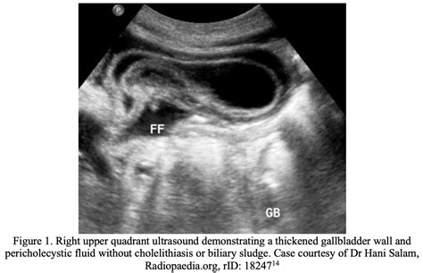 Emergency Medicine Educationacute Acalculous Cholecystitis In Adults Ed