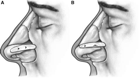 Grafts And Implants In RhinoplastyTechniques And Long Term Results