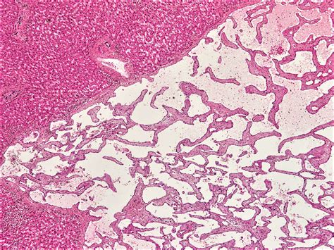 Capillary Hemangioma Lip Pathology Outlines | Sitelip.org