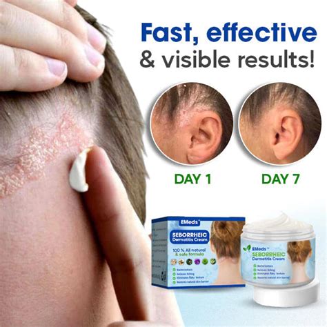 Seborrheic Dermatitis Cream – Beautykomi