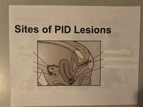 Sites of PID Lesions Diagram | Quizlet