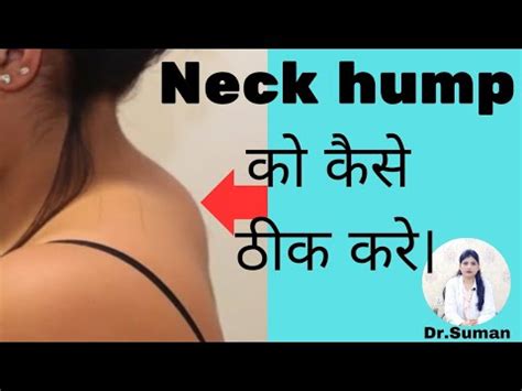 How To Fix Neck Hump At Home Fast With Easy Best Exercises In