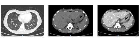 Patient Radiological Aspect At Total Body Computed Tomography CT Scan